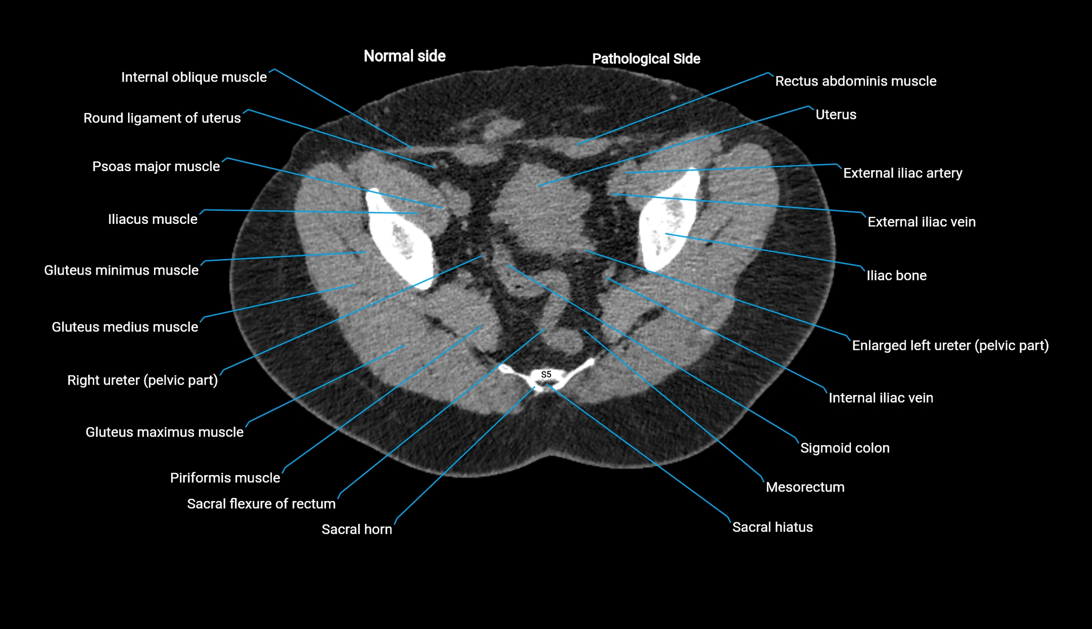 CT KUB axial cross sectional anatomy  radiology image -img-00201-00143.webp